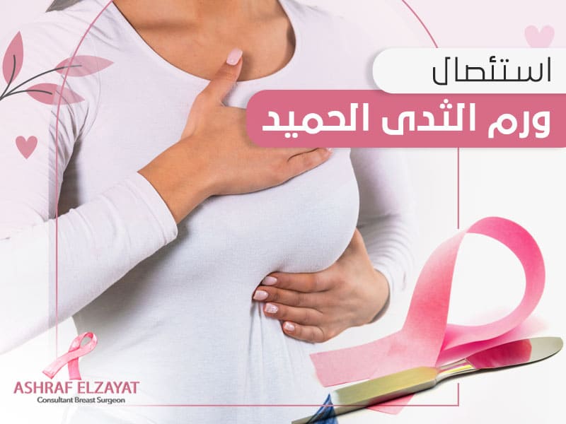 اورام الثدي الحميدة واعراضها - د اشرف الزيات