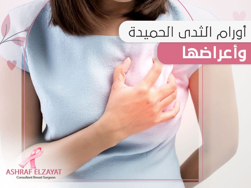 اورام الثدي الحميدة واعراضها - د اشرف الزيات