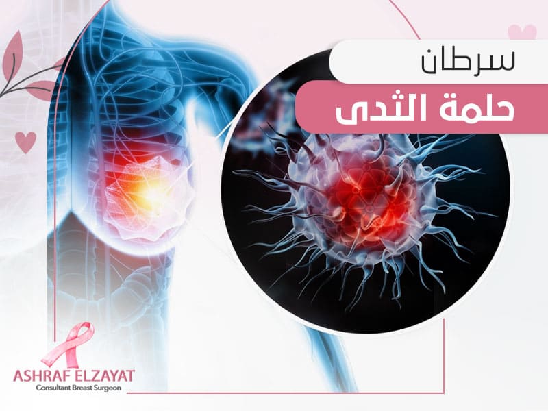 سرطان حلمة الثدي - د أشرف الزيات
